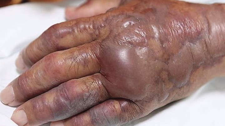 Τον ακρωτηρίασαν για να σώσουν τη ζωή του μετά τη μόλυνση από σούσι – ΦΩΤΟ