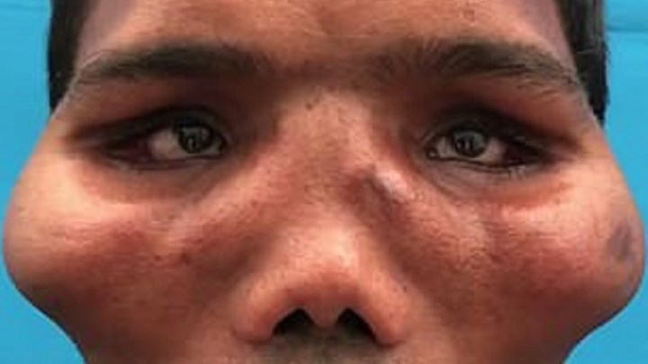 Άνδρας πάσχει από σπάνιο σύνδρομο – Η επέμβαση που του έσωσε τη ζωή και το πρόσωπο – ΦΩΤΟ – ΒΙΝΤΕΟ