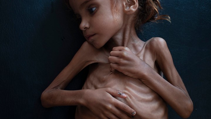 “Έσβησε” το κορίτσι-σύμβολο του λιμού στην Υεμένη – ΦΩΤΟ