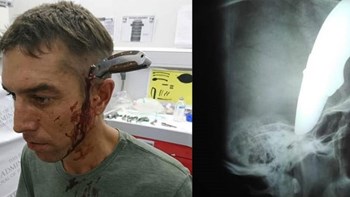 Πήγε στο νοσοκομείο με καρφωμένο ένα μαχαίρι στο κεφάλι- ΦΩΤΟ