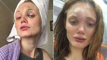 Μοντέλο της Vogue υπέστη άγριο ξυλοδαρμό από τον σύντροφό του – Σοκάρουν οι φωτογραφίες