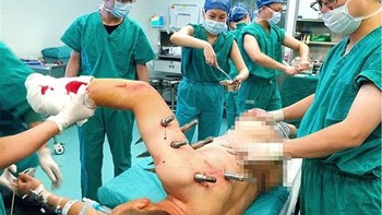 Ούτε στα θρίλερ: Ρομπότ “τρελάθηκε” και τραυμάτισε με καρφιά εργάτη εργοστασίου – ΦΩΤΟ – ΒΙΝΤΕΟ