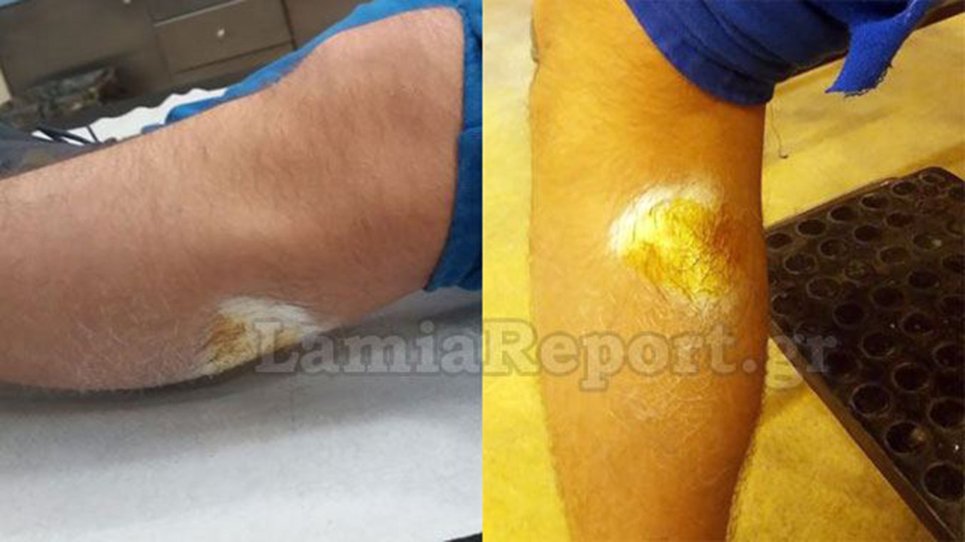 Σκύλος δάγκωσε μαθητή την ώρα που πήγαινε φροντιστήριο – ΦΩΤΟ