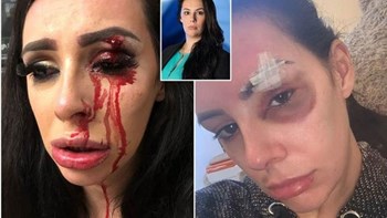 Θύμα άγριου ξυλοδαρμού γνωστή τηλεπερσόνα- ΦΩΤΟ