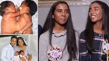 Συγκλονίζει η ιστορία σιαμαίων που τους είχαν δώσει μία στο εκατομμύριο πιθανότητα επιβίωσης – ΦΩΤΟ – ΒΙΝΤΕΟ