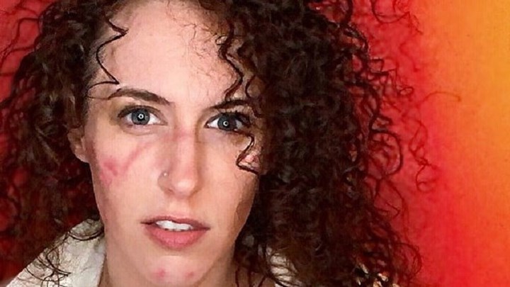 Κόλλησε μια σπάνια μόλυνση σε εξωτικό ταξίδι – Διαγνώστηκε με χολέρα – ΦΩΤΟ