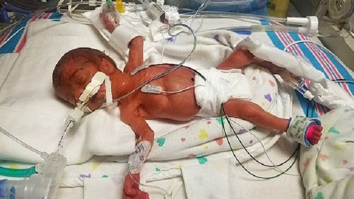 Μωρό-θαύμα γεννήθηκε στον 6ο μήνα της κύησης και κατάφερε να επιβιώσει