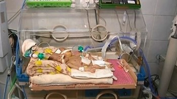 Πέθαναν τα σιαμαία που νοσηλεύονταν σε νοσοκομείο της Υεμένης