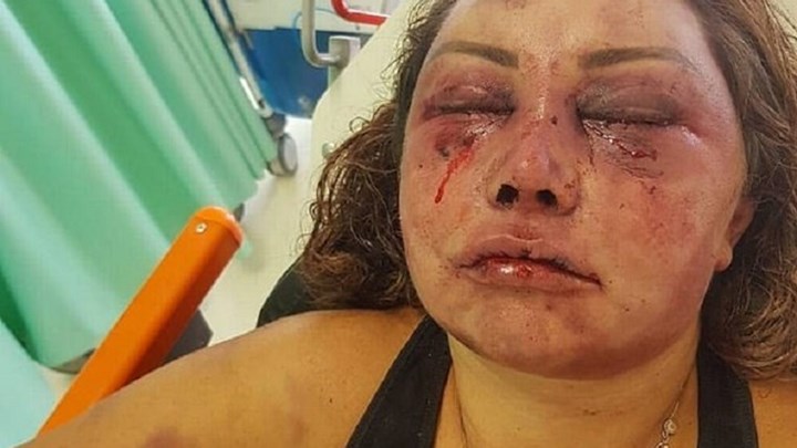 Γυναίκα δέχτηκε άγρια επίθεση από άνδρα που γνώρισε στο Διαδίκτυο – Σοκάρουν οι εικόνες