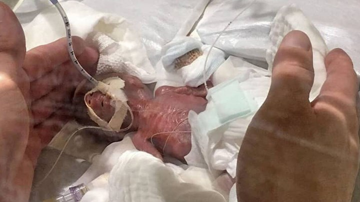 Κέρδισε τη μάχη για τη ζωή το βρέφος που γεννήθηκε 268 γραμμάρια
