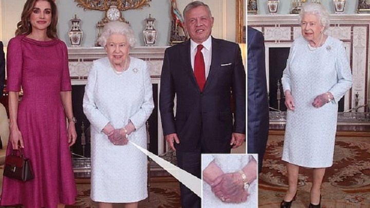 Γιατί είναι μελανιασμένο το χέρι της βασίλισσας Ελισάβετ; – ΦΩΤΟ