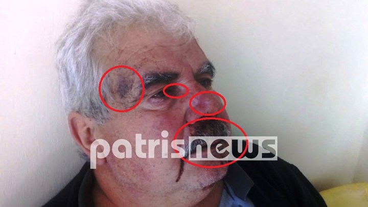 Ξυλοκόπησαν αγρότη που ζήτησε τα χρήματά του – ΦΩΤΟ