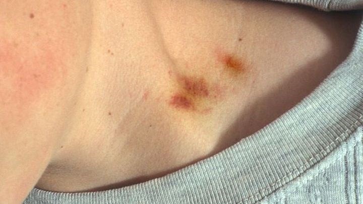 Φονική πιπιλιά – Πώς ένα παθιασμένο φιλί σκότωσε 17χρονο