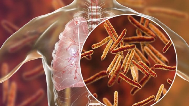 Καμπανάκι του Εθνικού Οργανισμού Δημόσιας Υγείας για τη φυματίωση: 580 άτομα νοσούν κάθε χρόνο στην Ελλάδα