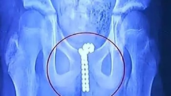 Η περιέργεια οδήγησε 11χρονο στο… χειρουργείο – Δεν φαντάζεστε τι έκανε – ΦΩΤΟ – ΒΙΝΤΕΟ