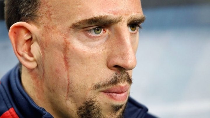 Συγκλονίζει ο Ριμπερί για το ατύχημα που είχε μικρός: «Ο κόσμος με κοιτούσε για τα σημάδια, η οικογένειά μου υπέφερε»