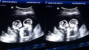 Επικό βίντεο- Ομοζυγωτικά δίδυμα “παλεύουν” μέσα στην κοιλιά της μαμάς τους