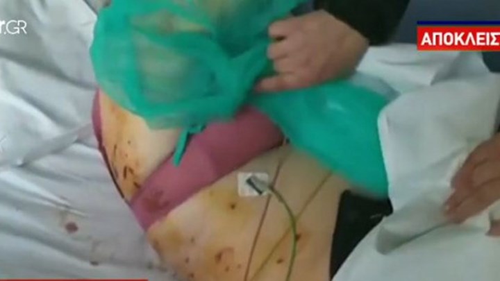 Σοκάρει η αρχαιοφύλακας που χτυπήθηκε από κεραυνό στην Ακρόπολη: Μία λάμψη με έριξε κάτω, δεν ξέρω πως βγήκα -ΒΙΝΤΕΟ