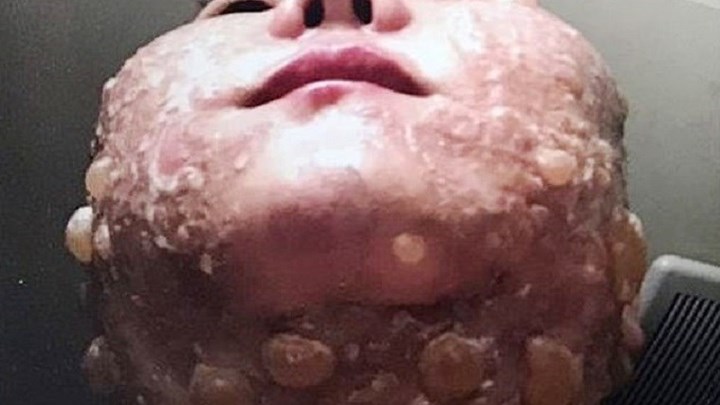 Στην εντατική έπειτα από λίφτνγκ προσώπου που της προκάλεσε φρικιαστικά εγκαύματα -ΦΩΤΟ