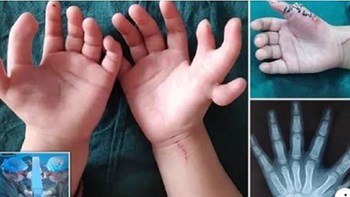 Γεννήθηκε με… 14 δάχτυλα λόγω κληρονομικότητας – ΦΩΤΟ