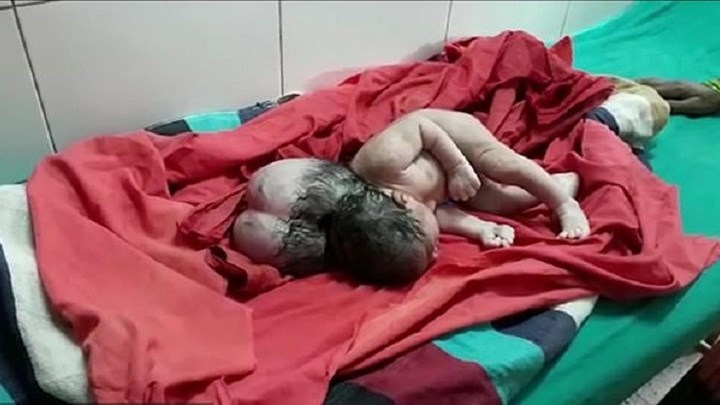 Σπάνιο ιατρικό φαινόμενο: Βρέφος γεννήθηκε με τρία κεφάλια στην Ινδία – ΒΙΝΤΕΟ