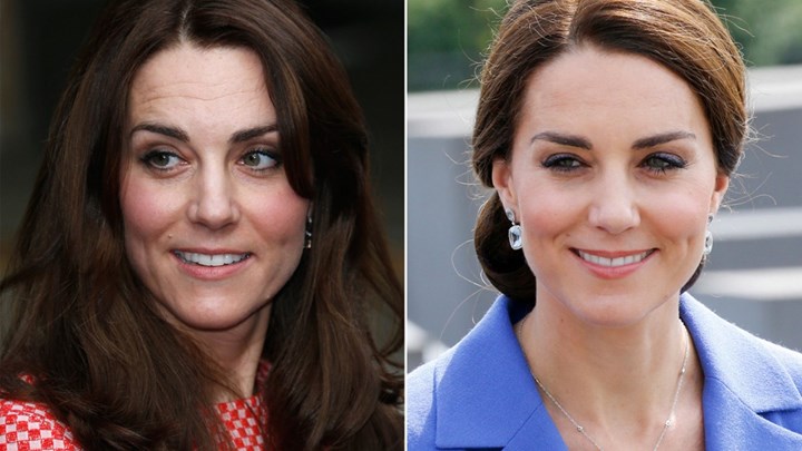 Έκανε “baby botox” η Κέιτ Μίντλετον; – Η ανάρτηση πλαστικού χειρουργού και η απάντηση από το Παλάτι – ΒΙΝΤΕΟ