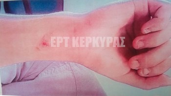 Καταγγελία-σοκ: Βασάνιζαν με καυτό λάδι σπουδαστή μαγειρικής σε γνωστό εστιατόριο της Κέρκυρας – ΦΩΤΟ