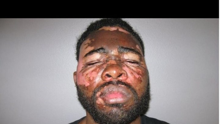 Θαρραλέα γυναίκα πέταξε καυτό λάδι στον διαρρήκτη του σπιτιού της