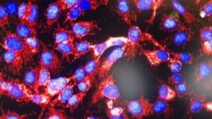 Έρευνα: Η διαταραχή μετατραυματικού στρες συνδέεται με αυξημένο κίνδυνο εμφάνισης καρκίνου των ωοθηκών