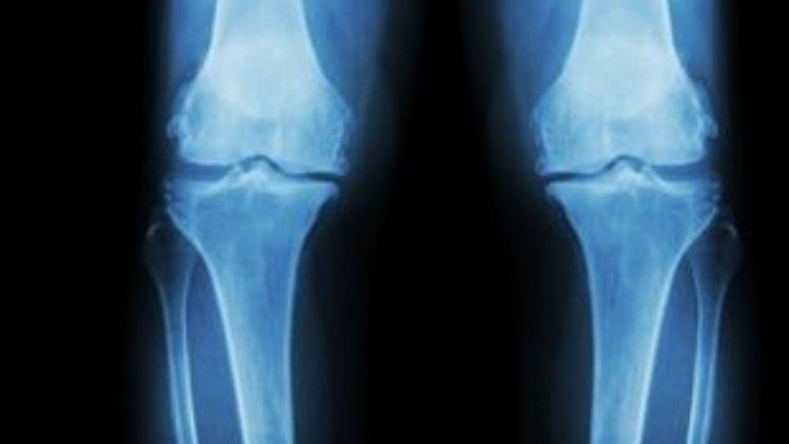 Αλλάζει ο τρόπος διάγνωσης και αντιμετώπισης της οστεοπόρωσης