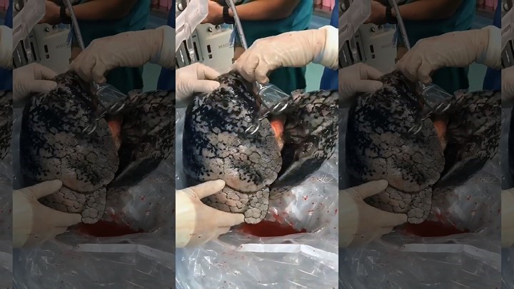 Γιατρός απέρριψε πνεύμονες από δωρητή οργάνων – Κάπνιζε για 30 χρόνια – ΦΩΤΟ – ΒΙΝΤΕΟ