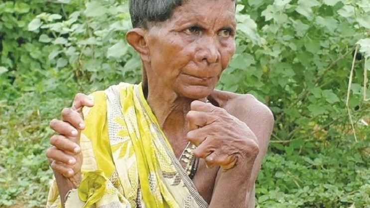 Τη θεωρούν “μάγισσα” γιατί έχει 19 δάχτυλα στα πόδια και 12 στα χέρια – ΦΩΤΟ – ΒΙΝΤΕΟ