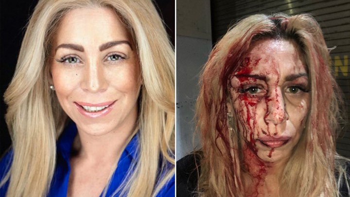 Άγρια επίθεση σε ένα μοντέλο και μια ηθοποιό έξω από μπαρ – Τις ξυλοκόπησαν ενώ έφευγαν