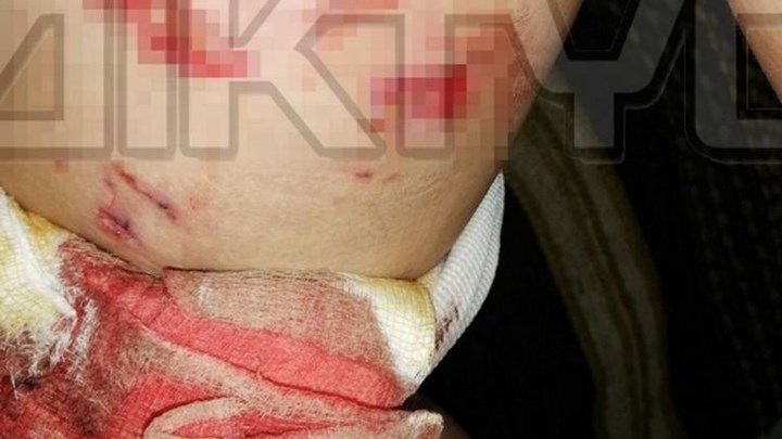 Σέρρες: Σκύλος επιτέθηκε σε παιδί – ΒΙΝΤΕΟ