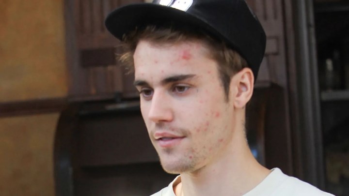 Τζάστιν Μπίμπερ: Αποκάλυψη-σοκ για το πρόβλημα υγείας που αντιμετωπίζει