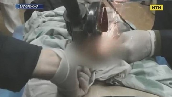 Φρικτή εκδίκηση: Του “φόρεσε” παξιμάδι στα γεννητικά όργανα επειδή την απάτησε – ΦΩΤΟ