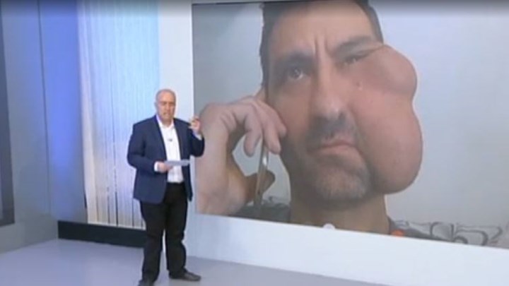 Η έκκληση ασθενούς με σπάνιο όγκο στο πρόσωπο για το δυσβάσταχτο κόστος της επέμβασης – ΒΙΝΤΕΟ
