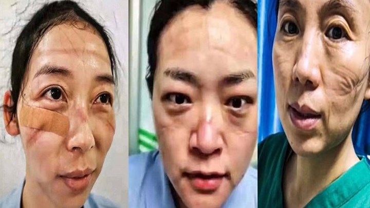 Κορονοϊός: Με μελανιές και σημάδια στο πρόσωπο οι νοσηλευτές της Γουχάν – Καταρρέουν από την κούραση