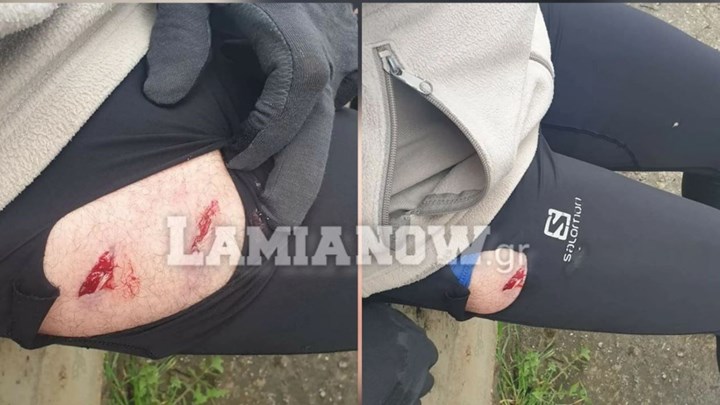 Λαμία: Πήγαν για τρέξιμο και τους επιτέθηκαν λυκόσκυλα – Συγκλονίζουν οι φωτογραφίες από τα τραύματα