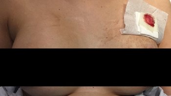 Η σιλικόνη της έσωσε τη ζωή – Πώς τα εμφυτεύματα στήθους άλλαξαν την τροχιά της σφαίρας – ΦΩΤΟ