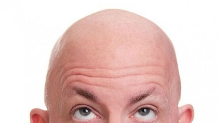 Κορονοϊός: Γιατί οι φαλακροί κινδυνεύουν περισσότερο