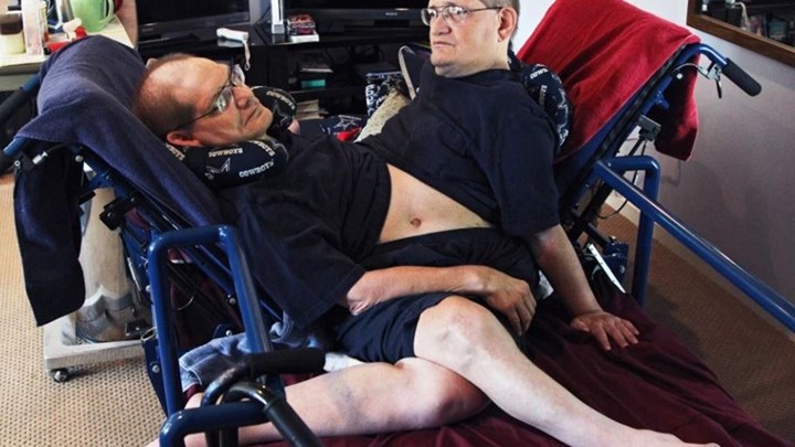 Πέθαναν οι γηραιότεροι σιαμαίοι – Ήταν ενωμένοι στην κοιλιά – ΦΩΤΟ