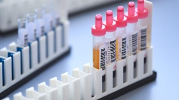 Κορονοϊός: Τα πρώτα αποτελέσματα από τη χορήγηση πλάσματος ιαθέντων στην Ελλάδα