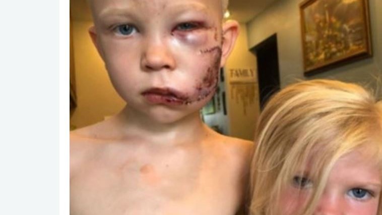 Όλος ο πλανήτης μιλά για τον 6χρονο ήρωα που έσωσε την αδελφή του – Κατέληξε με 90 ράμματα στο πρόσωπο