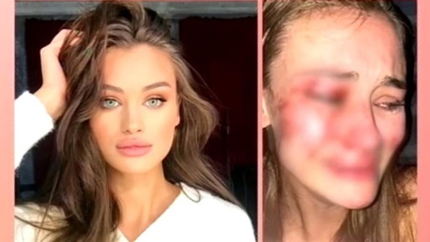 Τουρκία: Θύμα άγριου ξυλοδαρμού καταγγέλλει ότι έπεσε top model σε κλαμπ στο Τσεσμέ – ΒΙΝΤΕΟ