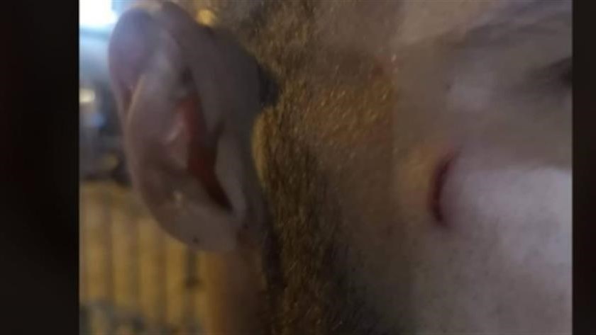 Ηλιούπολη: Χαράκωσαν στο πρόσωπο τερματοφύλακα σε φιλικό