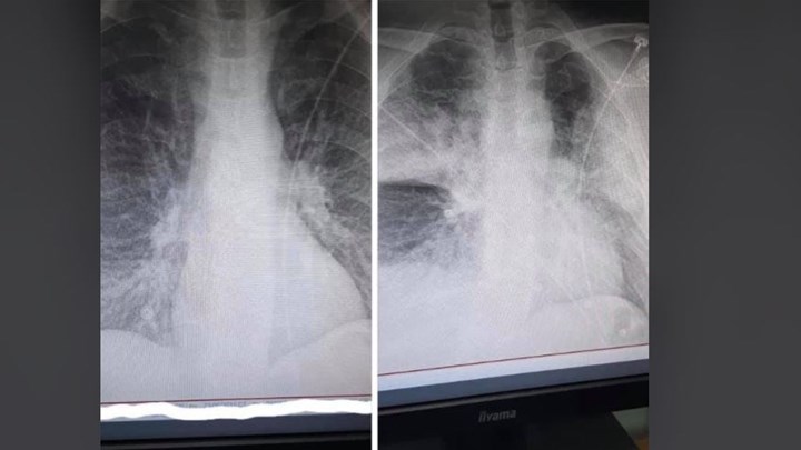 Η αλήθεια για τις φωτογραφίες με τις ακτινογραφίες ενός 38χρονου με κορονοϊό – ΦΩΤΟ
