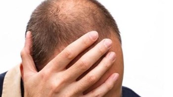Κορονοϊός: Γιατί εν μέσω πανδημίας μπορεί να χάνετε περισσότερα μαλλιά