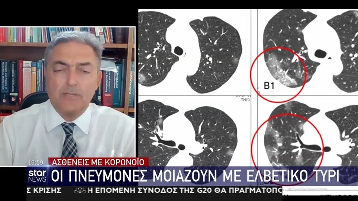 Κορονοϊός: Πώς μοιάζουν οι πνεύμονες των ασθενών – Δείτε την αξονική