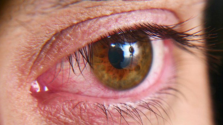 Κορονοϊός: Μολύνει και τα μάτια – Πώς εκδηλώνεται  – Τι έδειξε νέα μελέτη